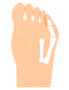 内反小趾