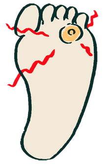 うおのめ